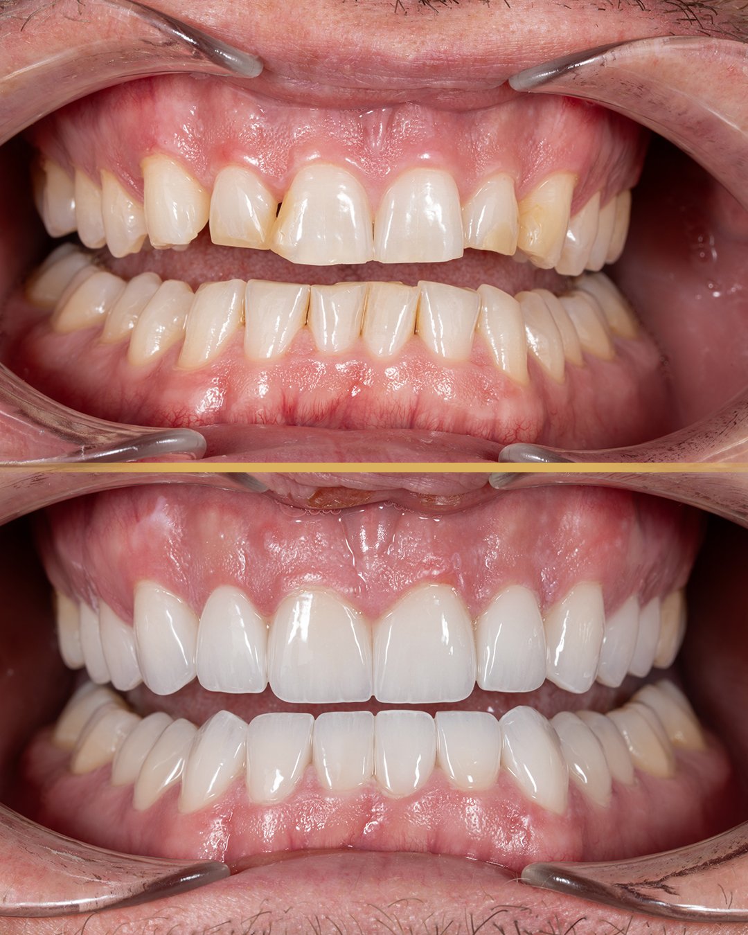 Faccette per denti gialli: quando lo sbiancamento non è sufficiente?